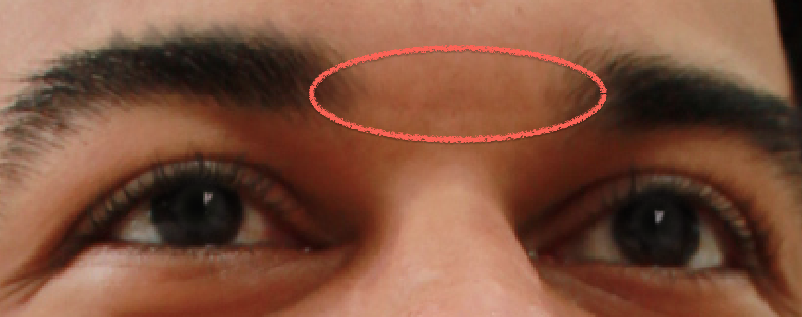 Use Healing Brush Tool on area between the eyebrows